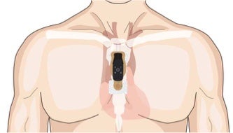Torso showing correct vertical placement of bridge