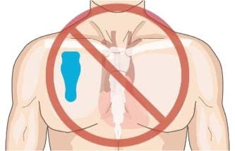 Torso showing incorrect placmement of strip
