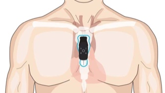 Torso showing correct vertical placement of strip