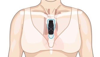 Female torso showing correct vertical placement of strip