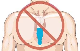 Torso showing incorrect vertical placement of strip