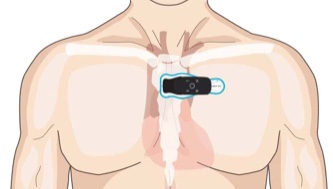 Torso showing correct horizontal placement of strip