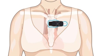 Female torso showing correct horizontal placement of strip