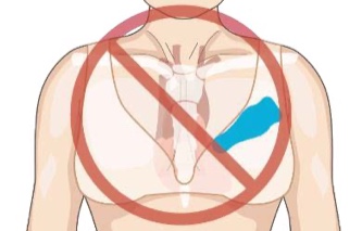 Female torso showing incorrect horizontal placement of strip