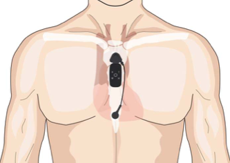 Torso showing placment of ECG leads