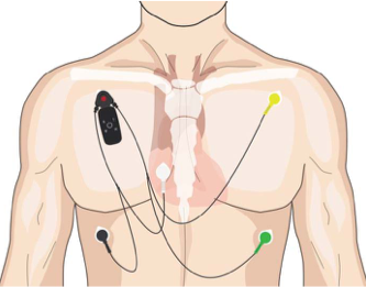 Torso showing placment of ECG leads