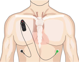 Torso showing placment of ECG leads