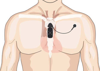 Torso showing placment of ECG leads