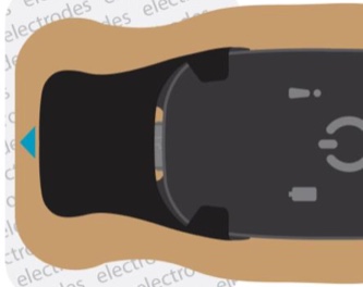 Close-up of BodyGuardian being poorly connected to Bridge