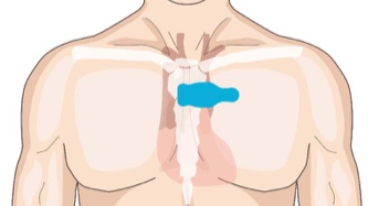 Torso showing correct horizontal placement of strip