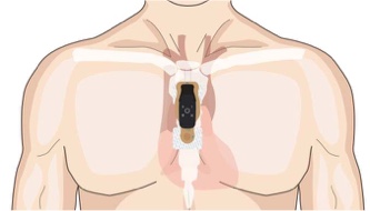 Torso showing correct vertical placement of bridge