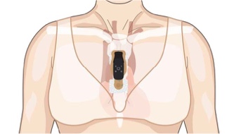 Torso showing correct vertical placement of bridge