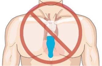 Torso showing incorrect placmement of strip