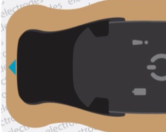 Close-up of BodyGuardian being adequately connected to Bridge